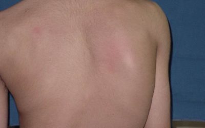 Escoliose