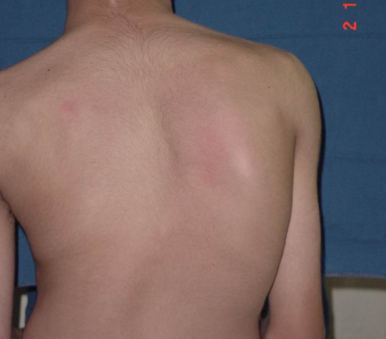 Escoliose