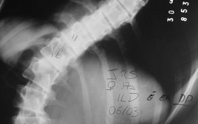 Escoliose: a cirurgia