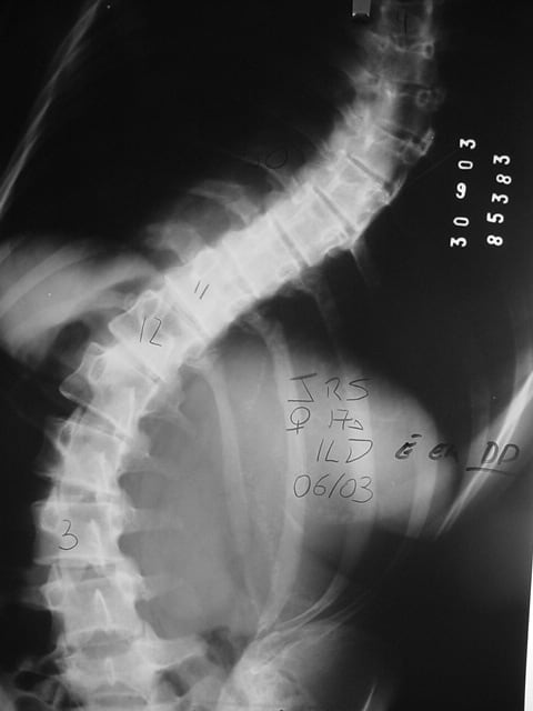 Escoliose: a cirurgia